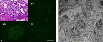 De novo podocytopathy following moderna COVID-19 vaccine: A case report and racial disproportionality in adverse effect reports